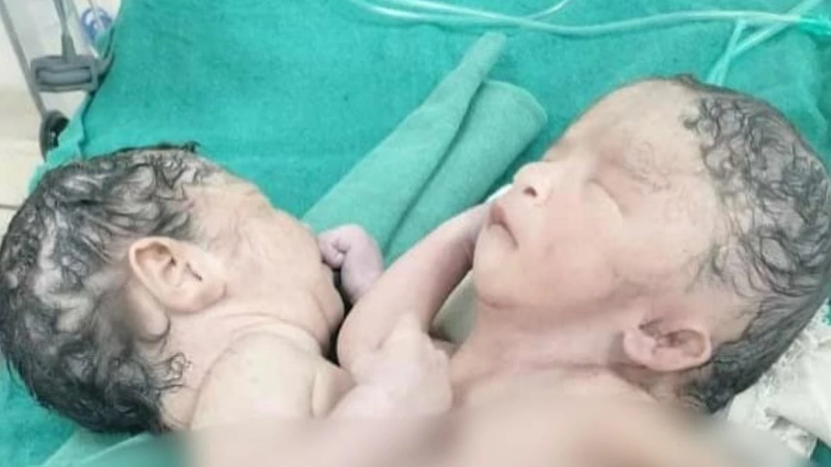 मध्य प्रदेश के इस जिले में हुआ अनोखे जुड़वां बच्चे का जन्म ?